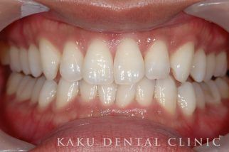歯のホワイトニング症例4