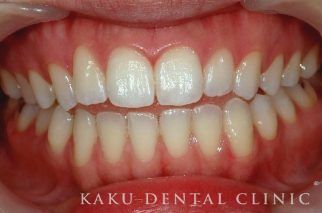 歯のホワイトニング症例5