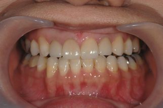 セラミクス修復治療　前歯部